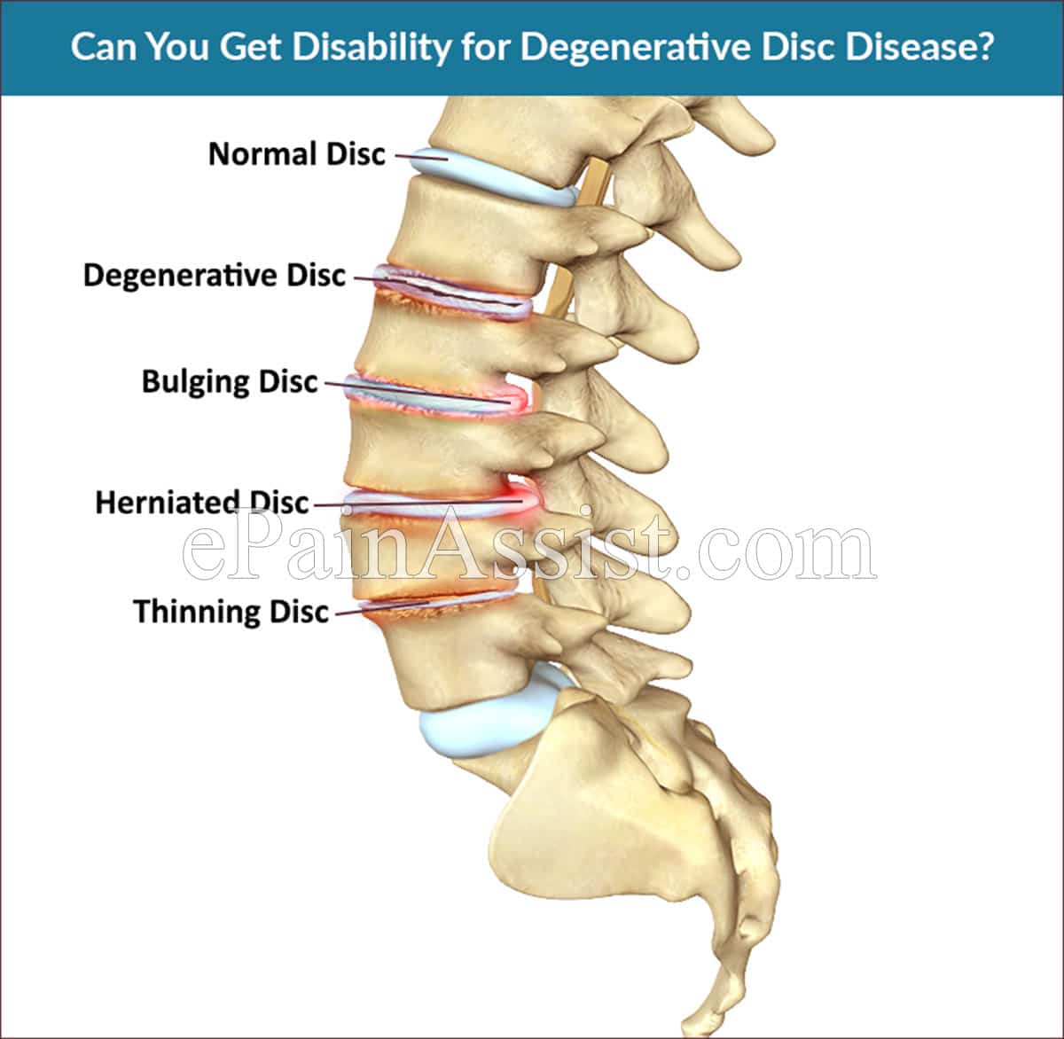 Disability Benefits for Degenerative Disc Disease