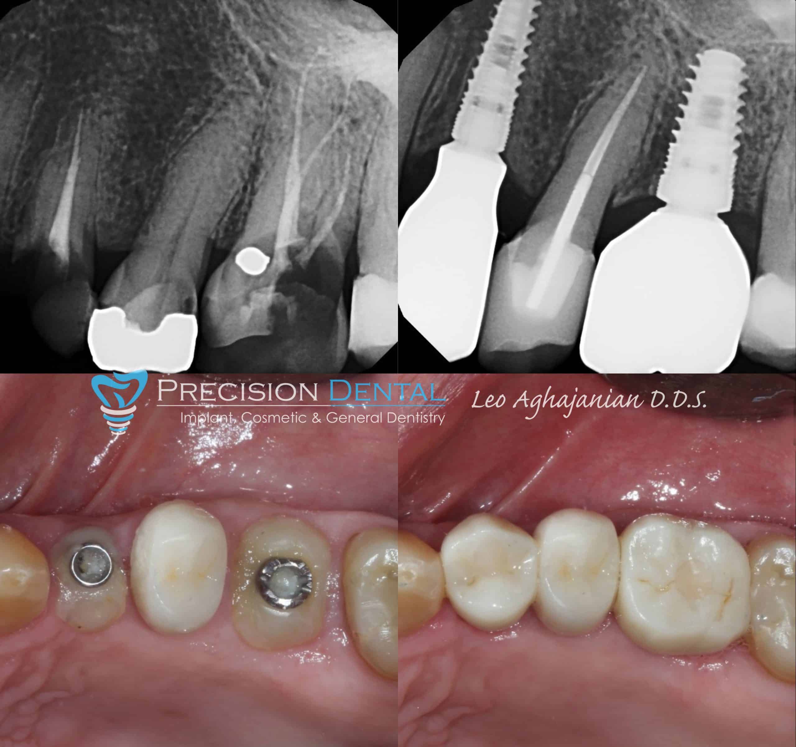 Smile Gallery, Before and After Dental Cases by Dentist Glendale